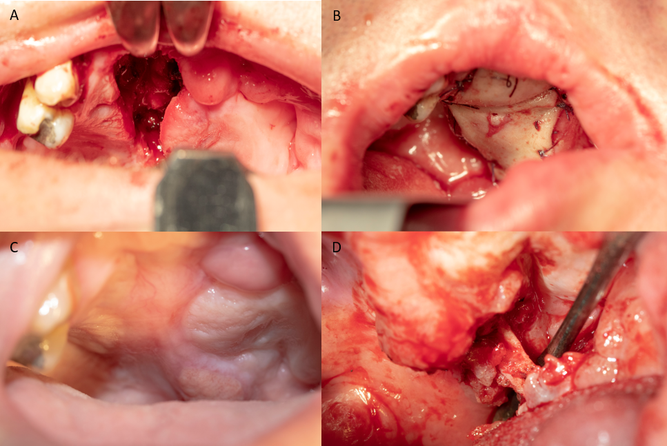 a) Preoperatice photo case 2. (b) Post operative photograph of case 2