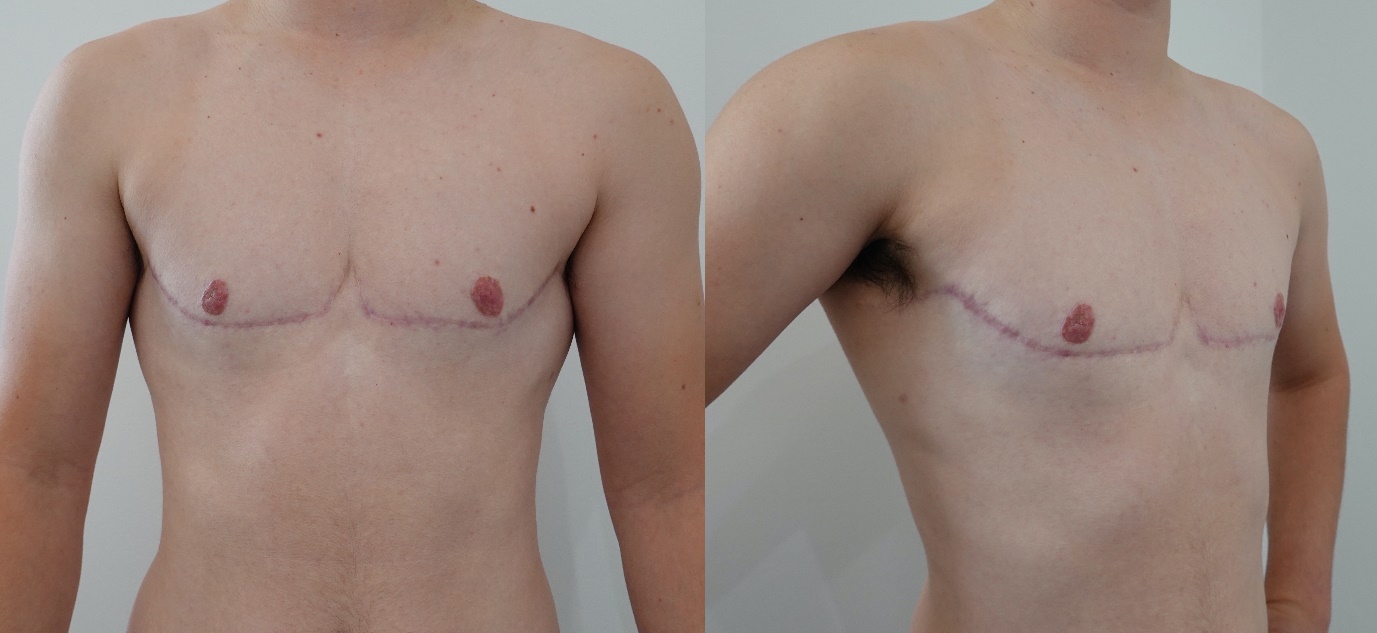 Here are some selfies of me with my top surgery scars from a