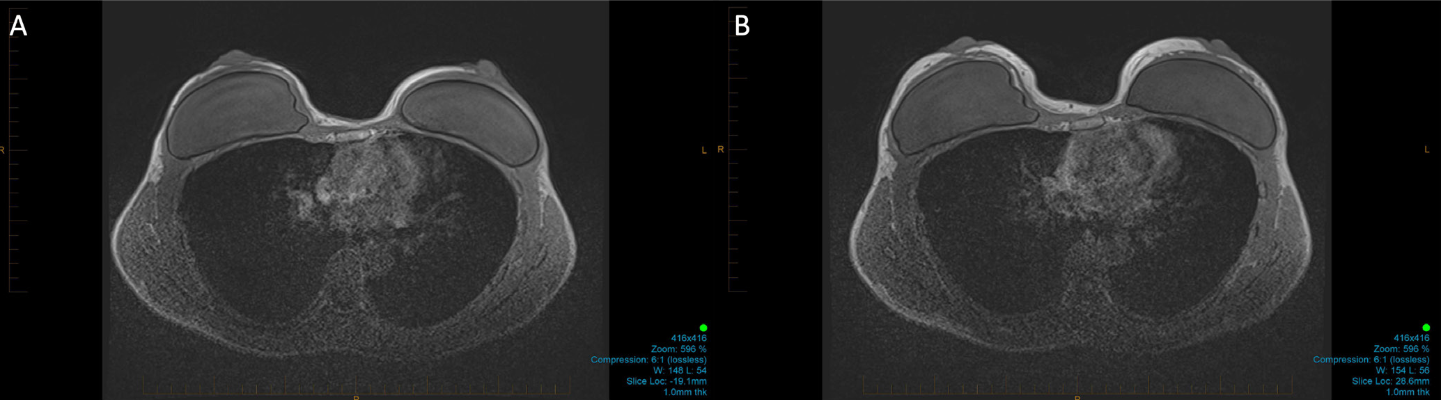 Volumetric assessment of fat graft retention over implant by MRI