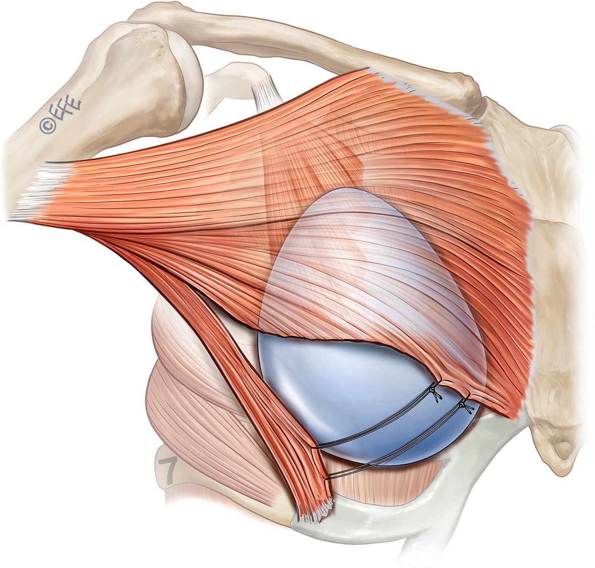 How to perform breast augmentation using a composite myofascial flap