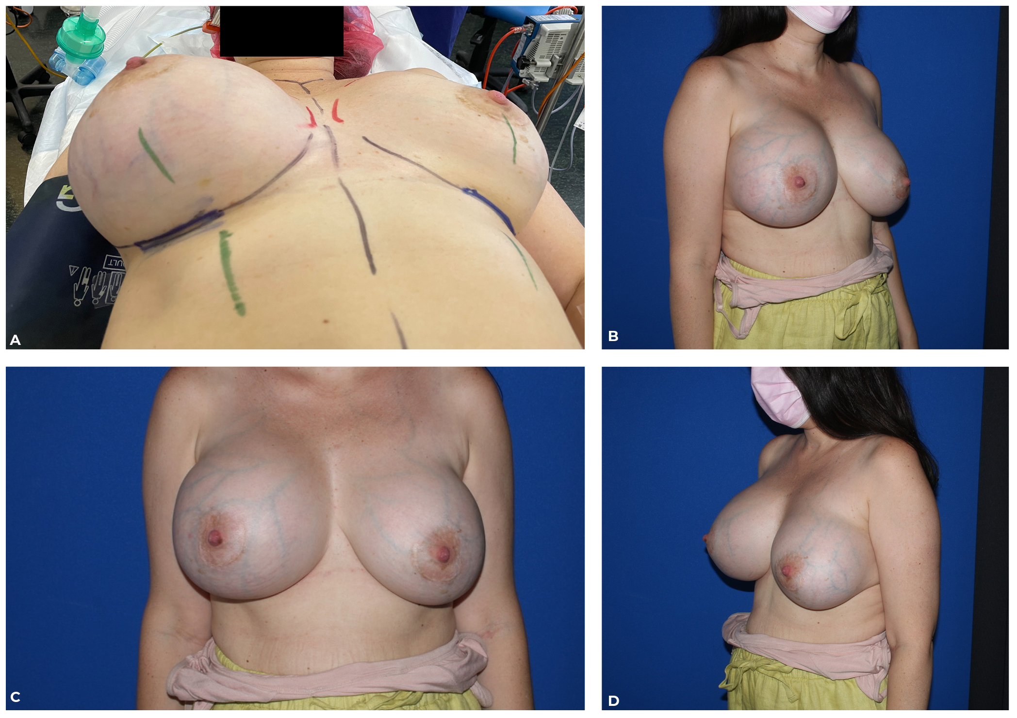 Breast milk intracapsular collection as a complication of periareolar  approach to breast augmentation: a case report | Published in Australasian  Journal of Plastic Surgery