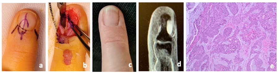 PDF] Synchronous subungual glomus tumors in the same finger. | Semantic  Scholar